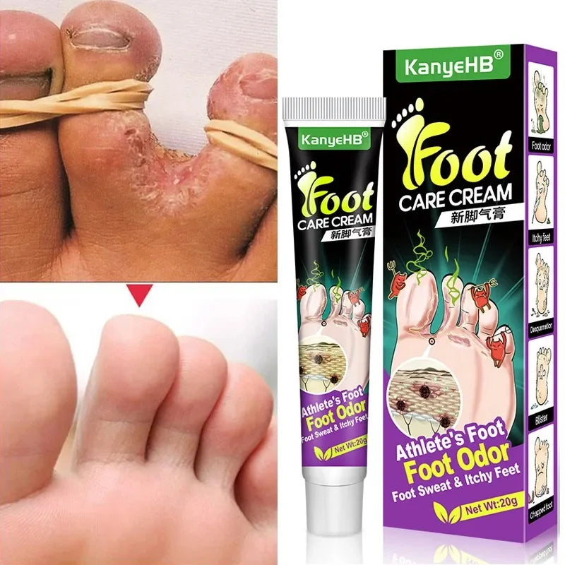 Foot Fungus Removal Cream Anti Fungal Infection Onychomycosis Paronychia Remove Beriberi Dead Skin Repair Foot Cracked Feet Care