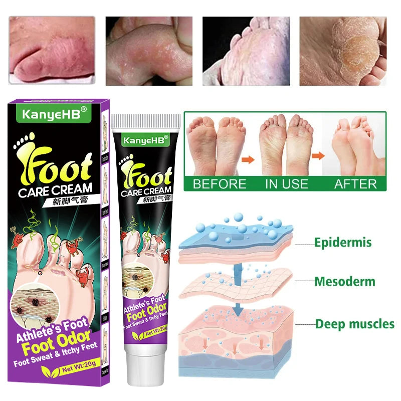 Foot Fungus Removal Cream Anti Fungal Infection Onychomycosis Paronychia Remove Beriberi Dead Skin Repair Foot Cracked Feet Care