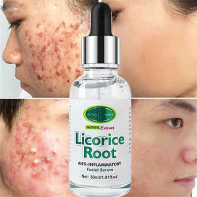 30ML Licorice Root Face Serum Anti-acnes Minimizes Pores Skin Care Facial Essencial Anti-Inflammatory Lighten Spots Essence