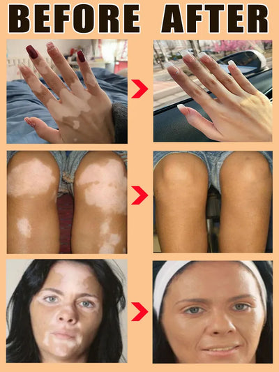 Vitiligo treatment cream Vitiligo relief spray Skin treatment lamp White Spot Removal vitiligo ointment Eliminate Vitiligo