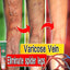 Varicose Vein Treatments Cream Effective Relieve Legs Dilated Vasculitis Phlebitis Natural Formula Ointment For Varicose Veins