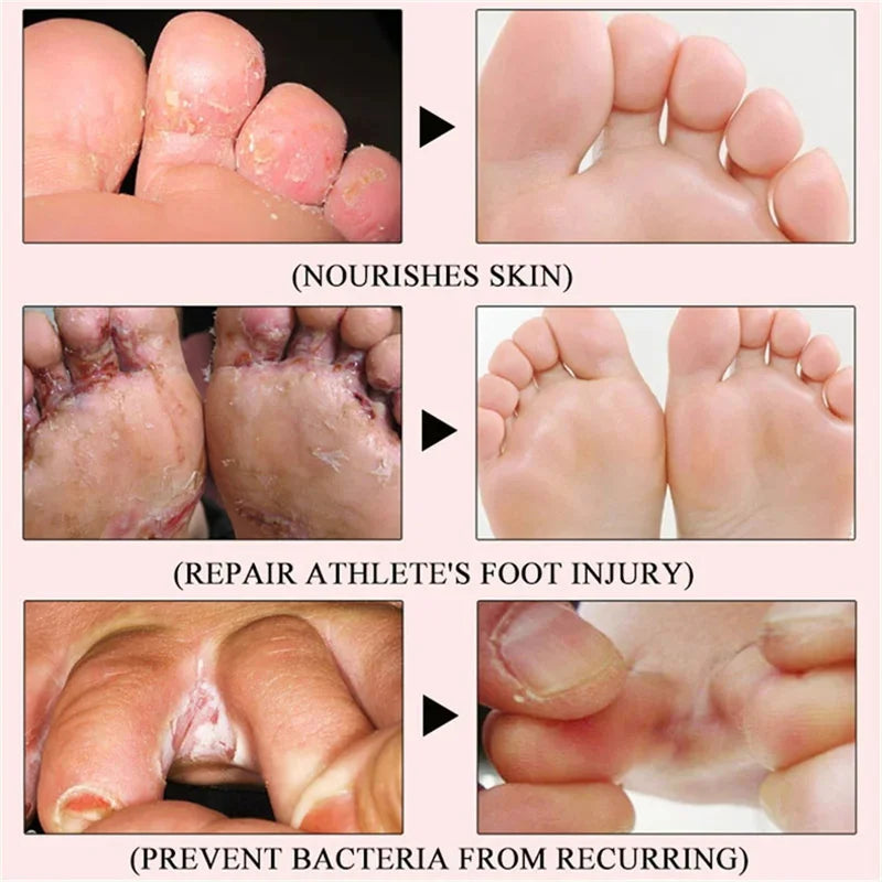 Foot Fungus Removal Cream Anti Fungal Infection Onychomycosis Paronychia Remove Beriberi Dead Skin Repair Foot Cracked Feet Care