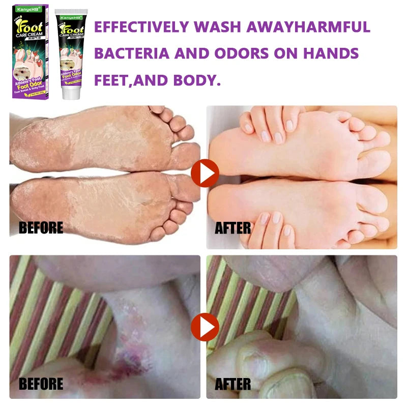 Foot Fungus Removal Cream Anti Fungal Infection Onychomycosis Paronychia Remove Beriberi Dead Skin Repair Foot Cracked Feet Care